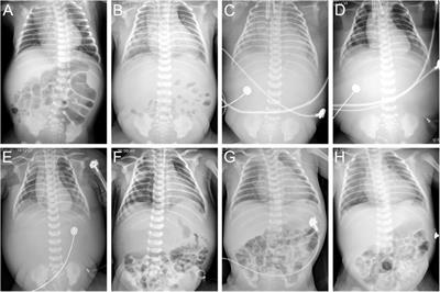 V-A ECMO for neonatal coxsackievirus B fulminant myocarditis: a case report and literature review